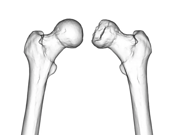 découvrez l'innovation des fémurs 3d et leur impact sur la biomécanique. apprenez comment la modélisation 3d transforme les approches chirurgicales et améliore la compréhension des mouvements humains.