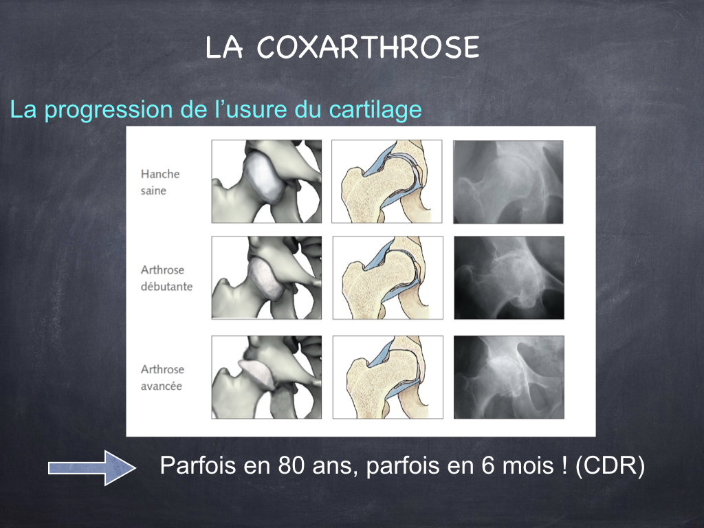 discover the innovation of 3d femurs and their crucial role in biomechanics. explore how advanced modeling and 3d printing are transforming medical research and applications to improve the treatment of bone pathologies.